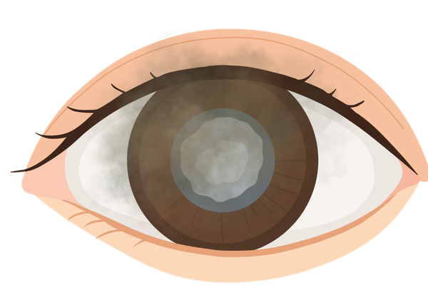 esquema de un ojo con catarata