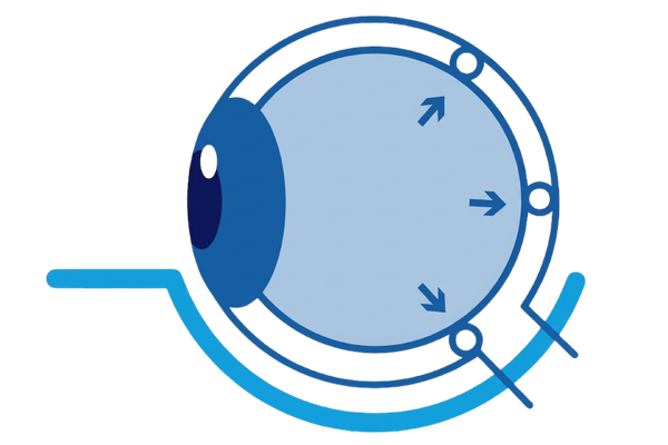 glaucoma y pérdida de visión
